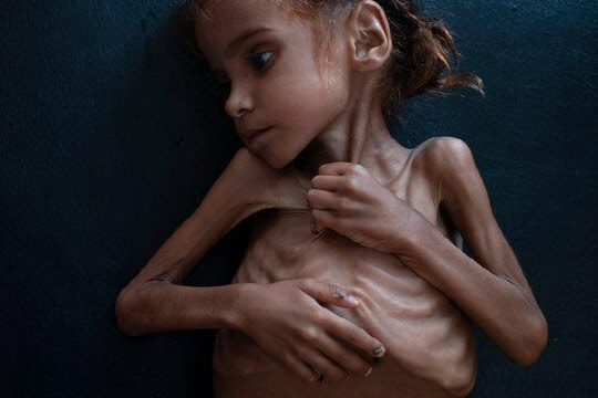 `예멘 고통의 상징` 7세 소녀 결국 하늘로